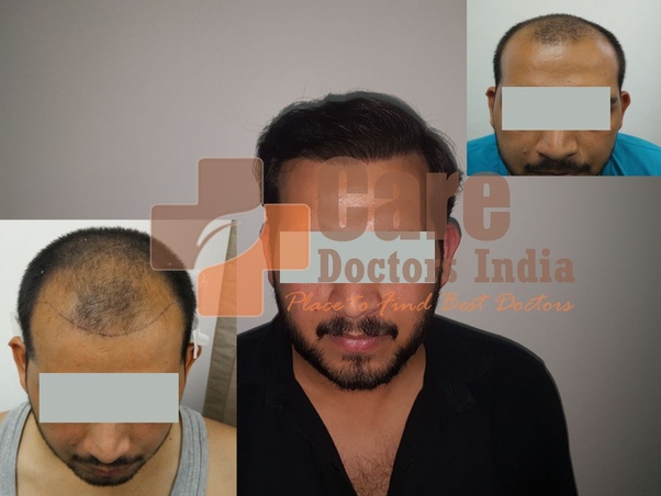 How much does it cost to get hair transplant in Australia? Quora