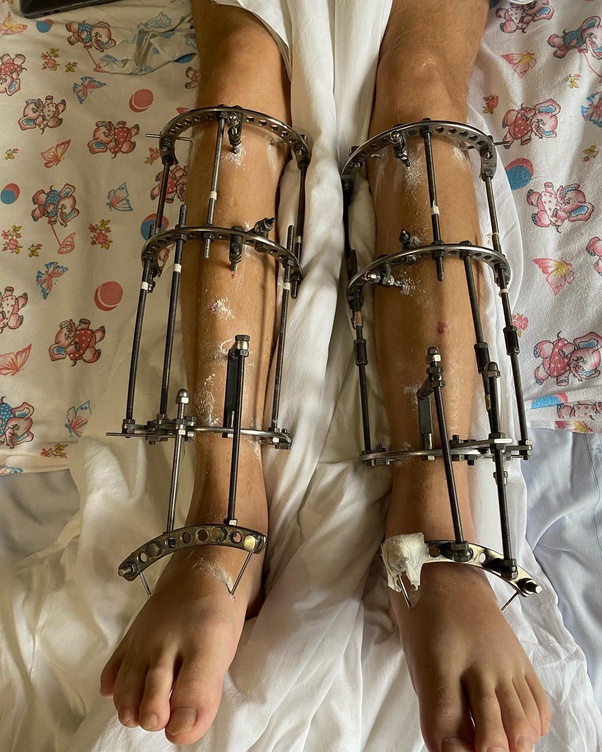Should I go for a limb lengthening operation to increase
