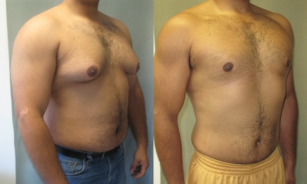 What do you think would be the cost of surgery in India