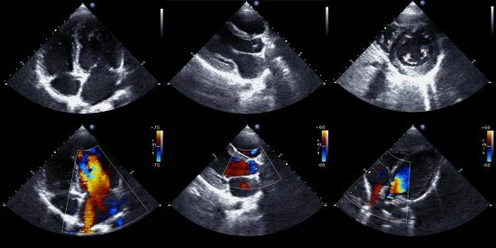What is an echo ultrasound? Quora