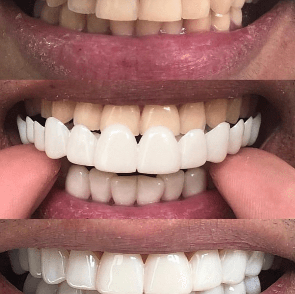 What do you think of clip on veneers for that instant