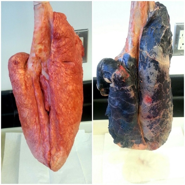 What does brown phlegm mean? I'm a heavy cigarette smoker. Quora