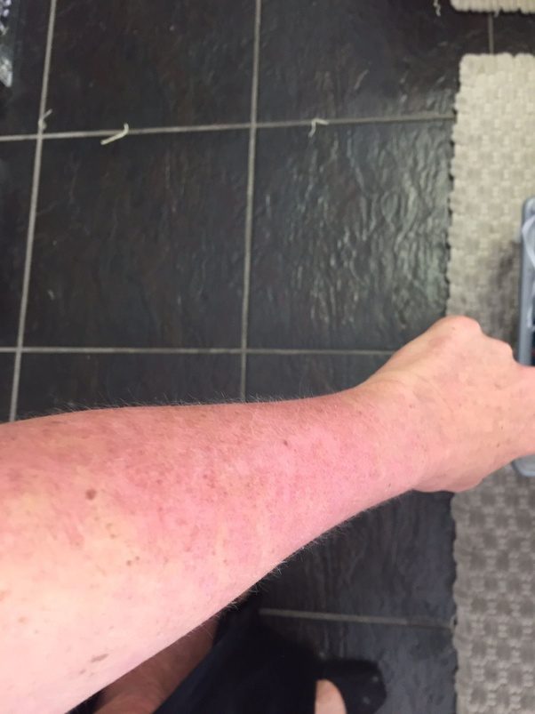 How can the lupus rash be treated? Quora