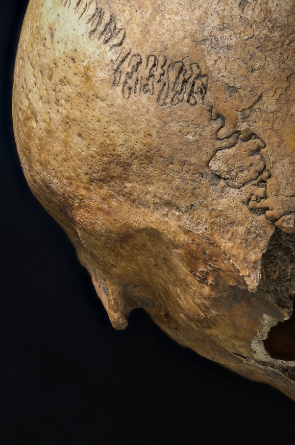 Why do I have a bone bump on the back of my skull? Quora