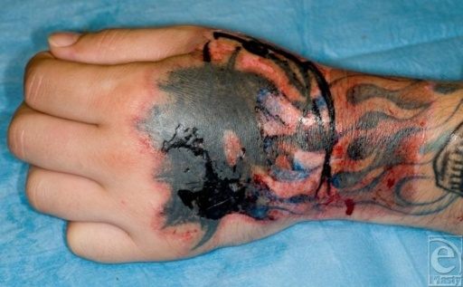 Does TCA (TriChloroacetic Acid) work for athome tattoo removal? Quora