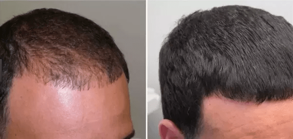By using minoxidil, is new hair growth permanent or temporary? Quora
