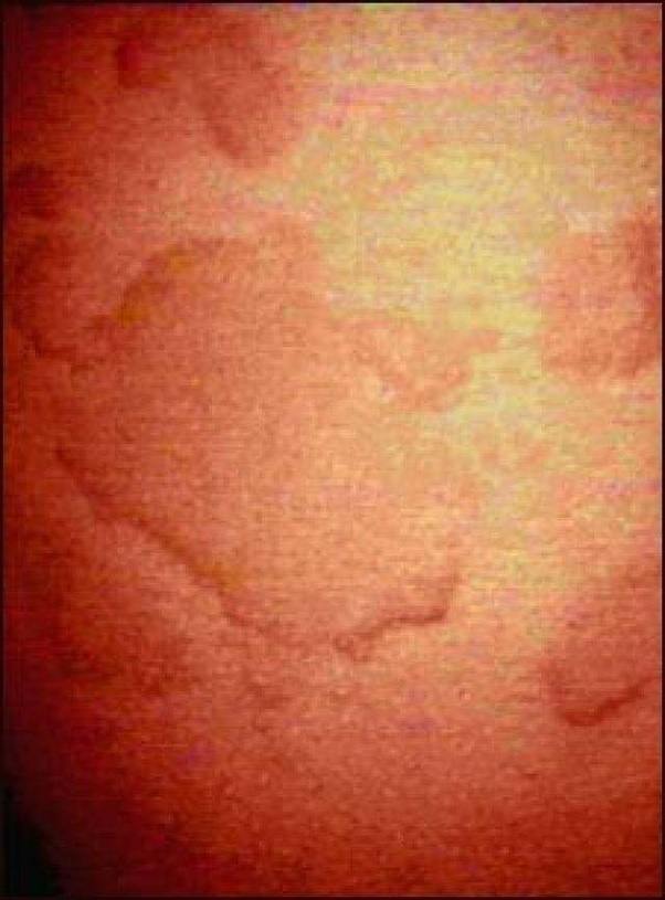 Why do I break out in a couple of hives only on my stomach or back area