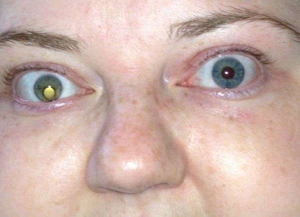 Can someone be born with both Heterochromia Iridum so one