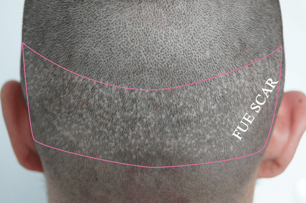Are there scars after an FUE transplant? Are they visible later at all