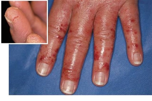 What are the symptoms of being allergic to acrylic nail tips? Do the
