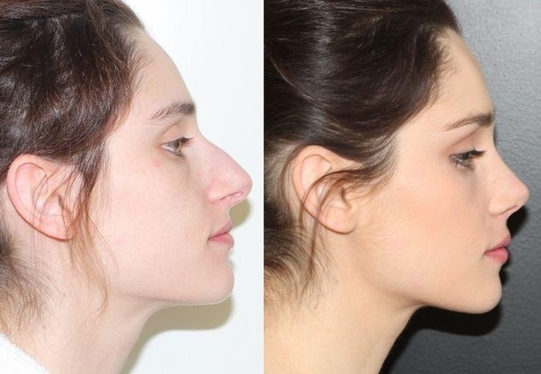 How much rhinoplasty cost? Quora