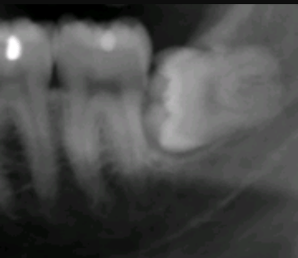 What happens when you don't remove a nonimpacted wisdom tooth? Quora