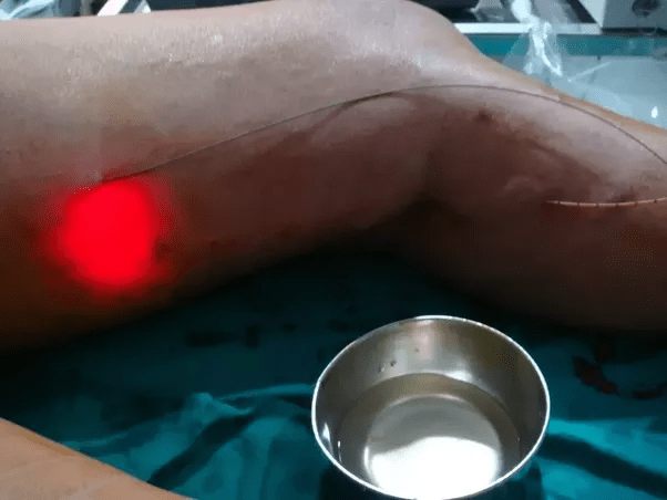 Does Varikostop cream cure varicose veins or does it make them