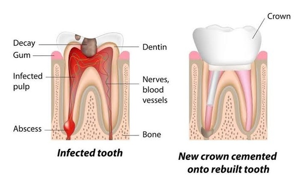 In general, how long will the tooth last after root canal, adding
