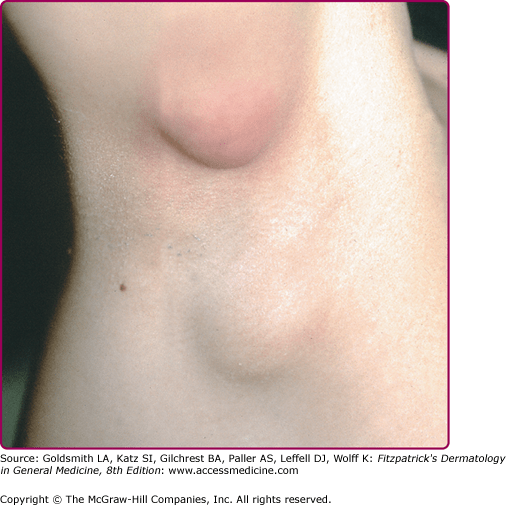 What are the treatments for painful bumps on your armpit? Quora