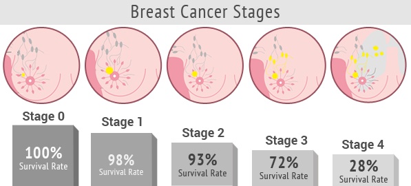 What are the stages of breast cancer? Quora