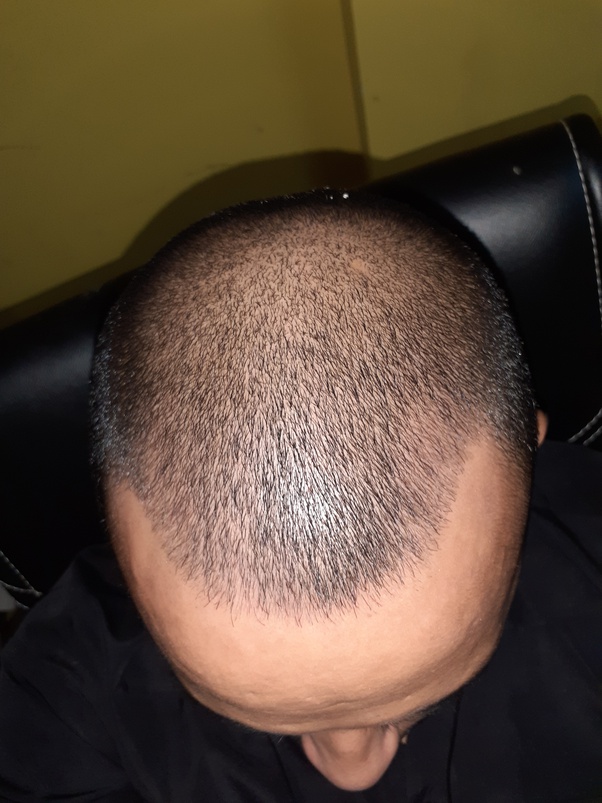 Hair Crown Thinning Reddit