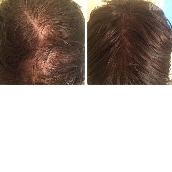 How to block DHT from my scalp Quora