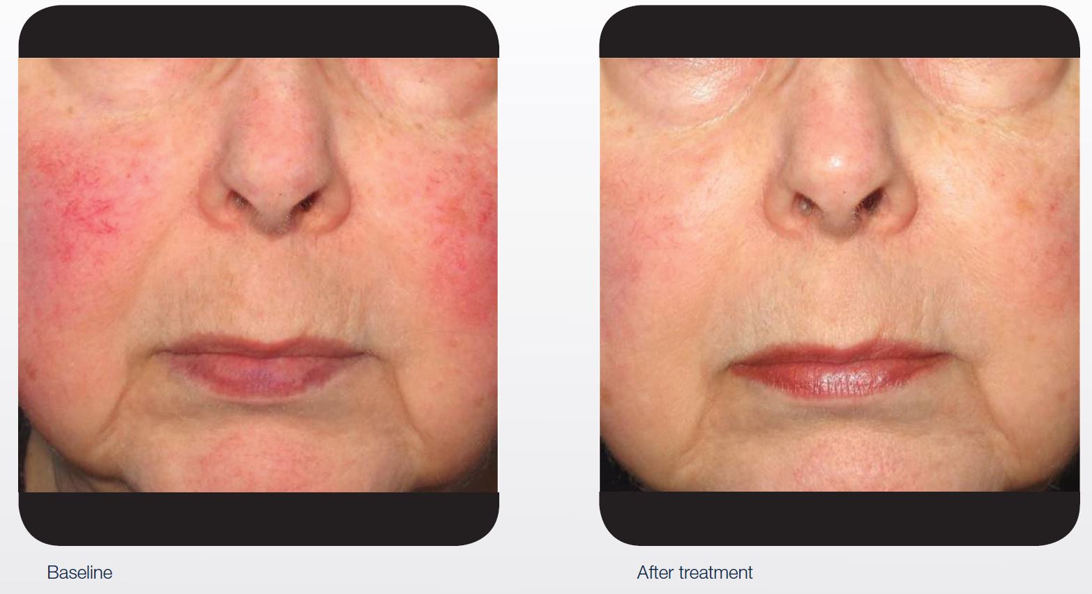 IPL/laser for redness & broken capillaries QSD