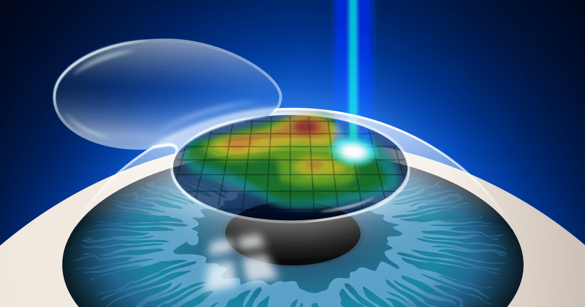 LASIK, Wavefront, and PRK ⋆ QT Optometry