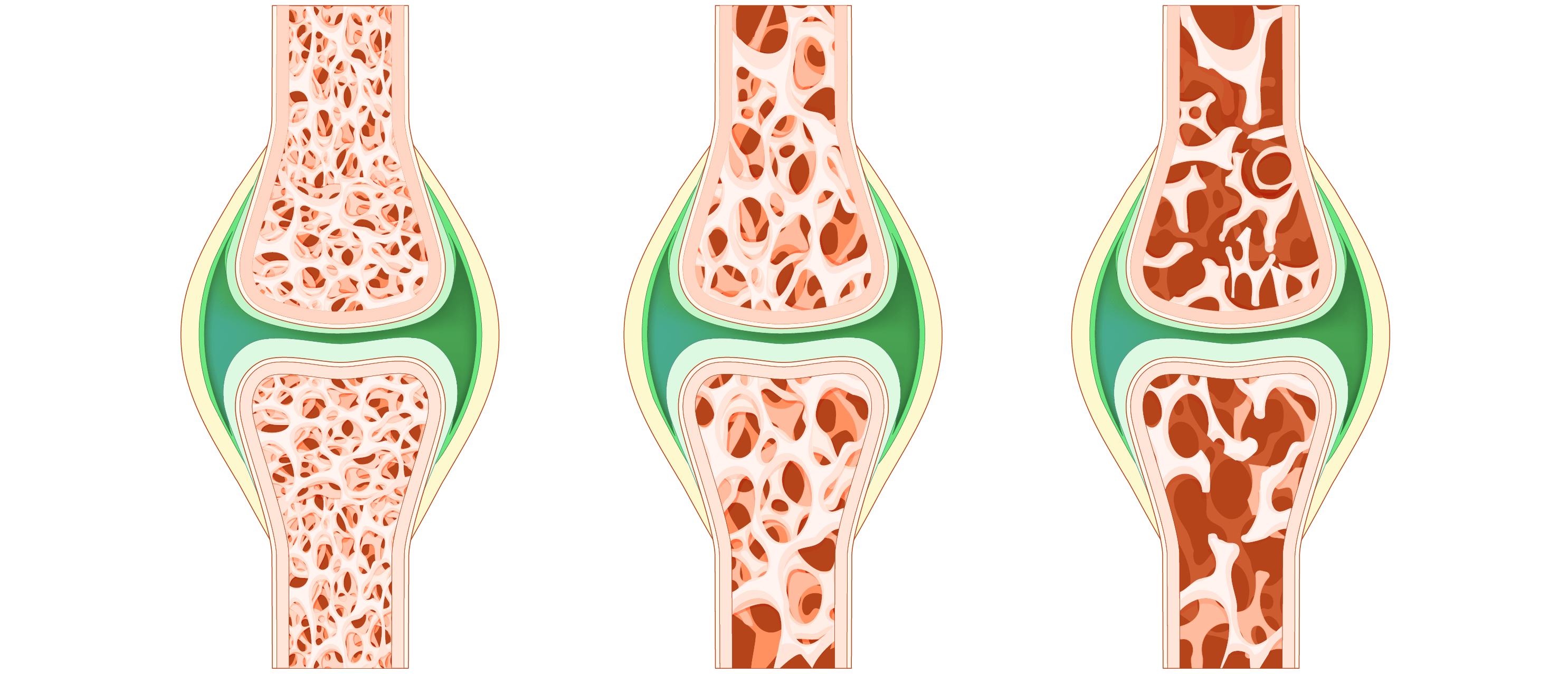 Osteoporosis Quantify Research