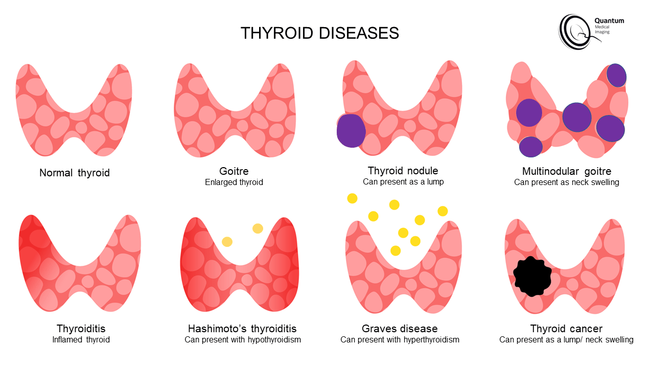 The Thyroid Quantum Medical Imaging