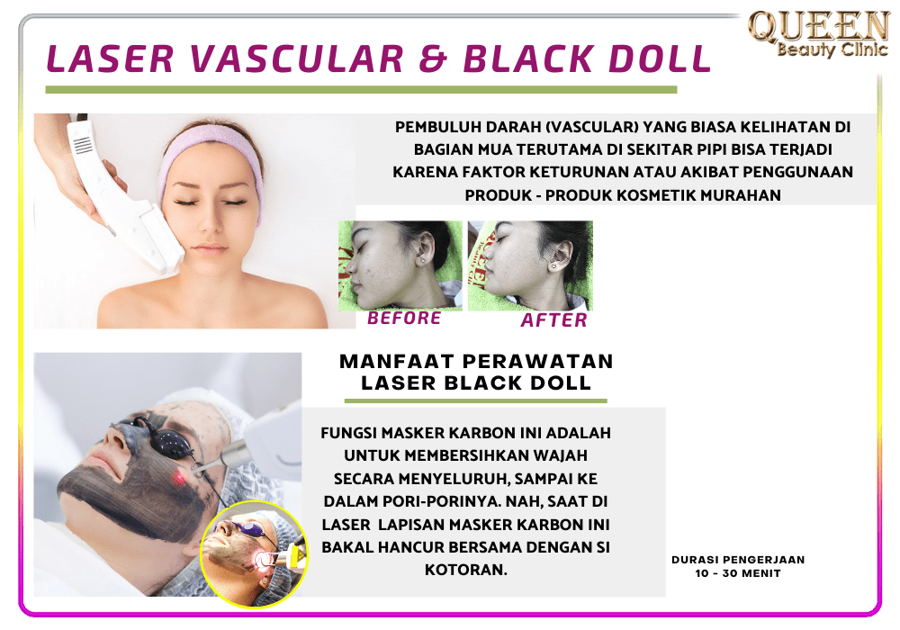Laser Blackdoll Klinik Bedah Plastik Queen
