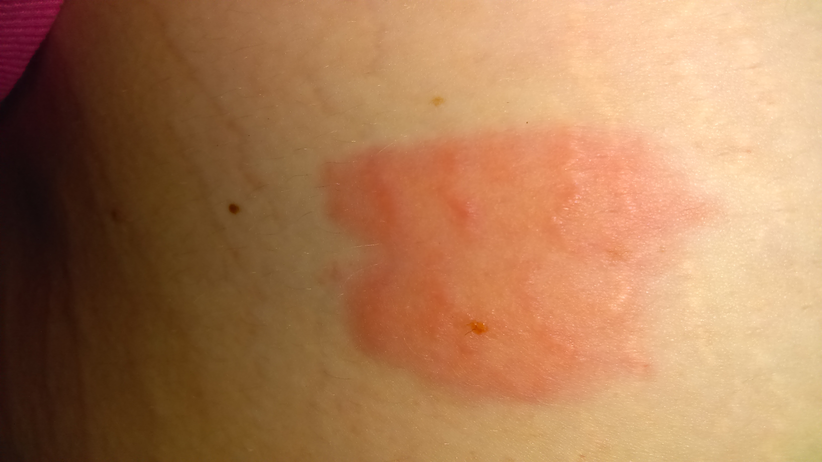 Question Felt a stinging pain then a sharp pain...fang marks Ask a