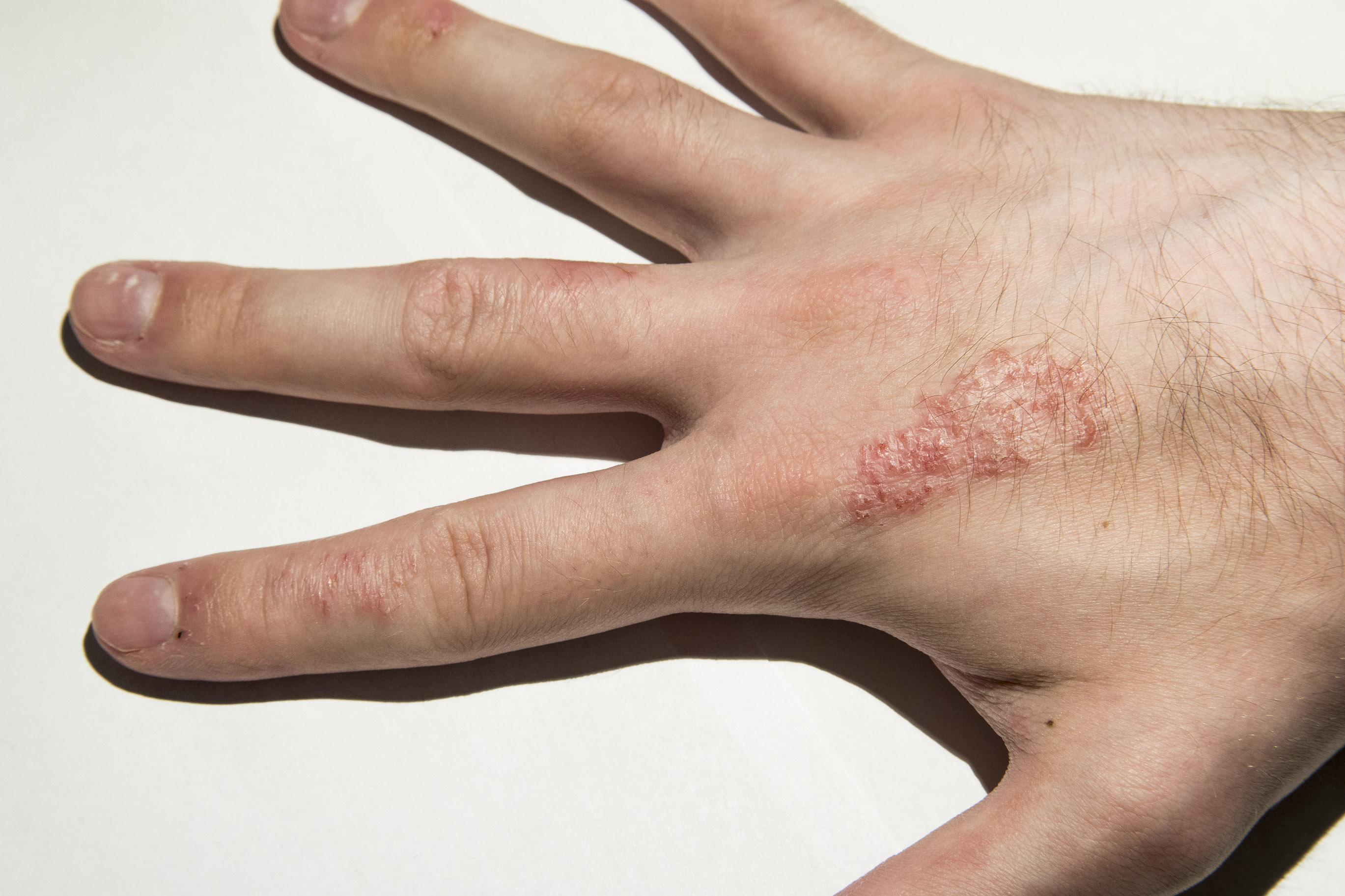 I have a skin disease, but no idea what it is? Ask a doctor free