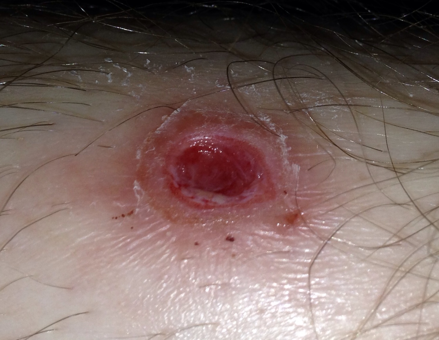 How do I get rid of ulcers on my legs? Ask A Doctor Free Best