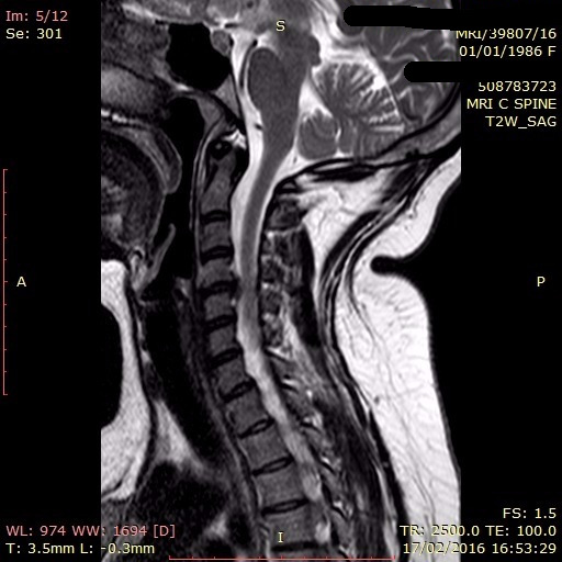 I have a problem with the disc dislocation CD4CD5 of the cervical