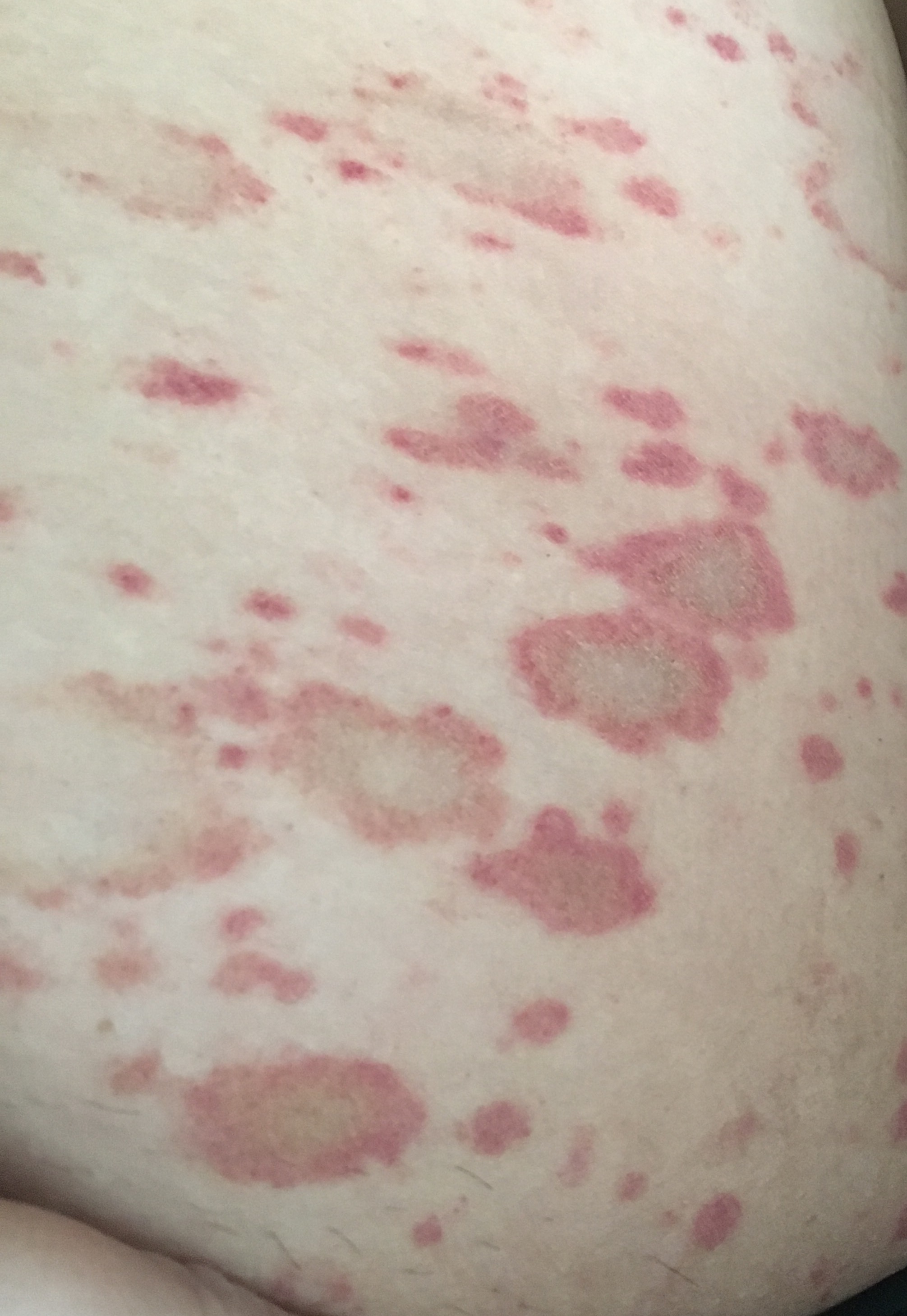 I have a rash, thought it might be some type of fungus, doc says
