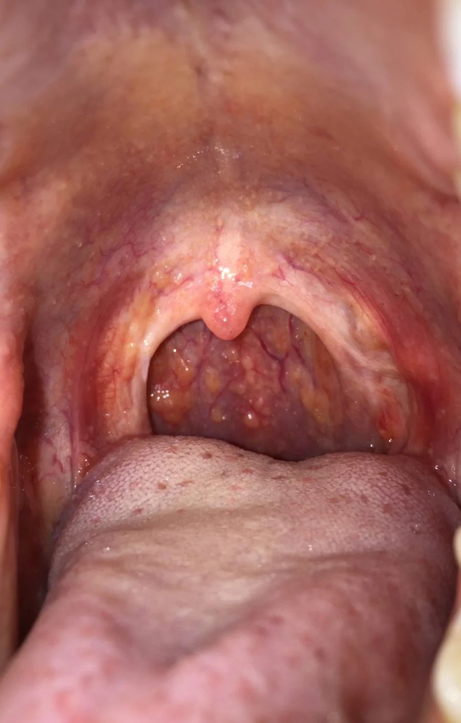I have yellow bumps in my throat? Ask A Doctor Free Best Advice