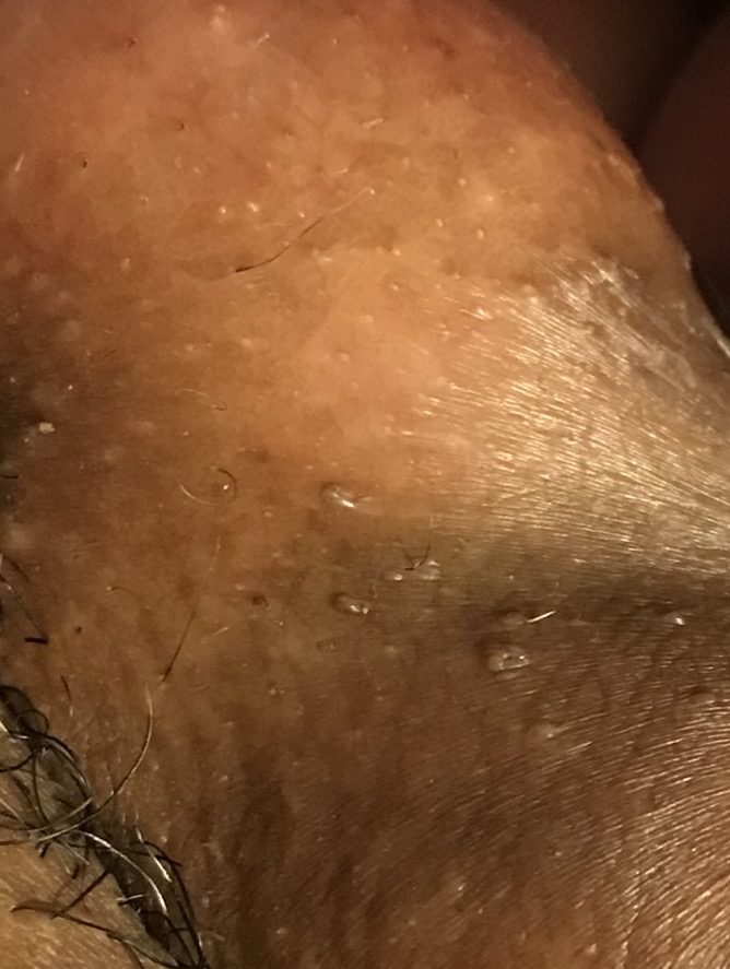 I noticed I had this small dark warts/bumps? Ask A Doctor Ask