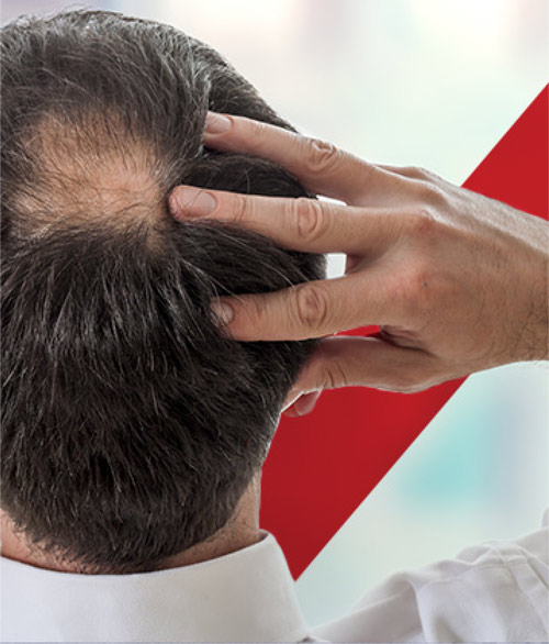 Wat Zi̇jn İndi̇cati̇es Voor Haartransplantati̇e, Hoe Wordt Het Toegepast? | Quick Change Center