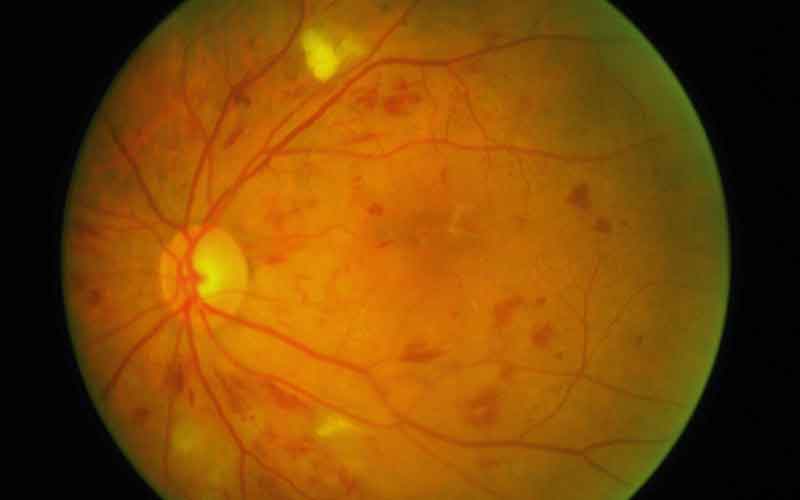 Diabetic Retinopathy. You May Not Know You Have It. Quigley Eye Specialists