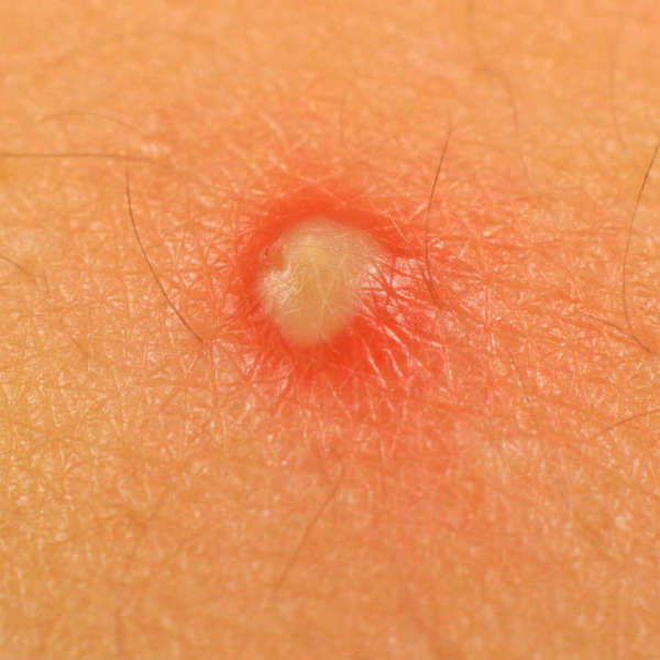 Pop A Pimple Properly Without Leaving A Scar