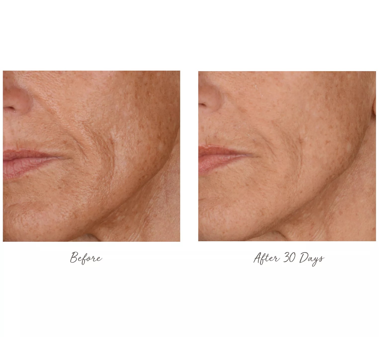 (QVC) BeautyBio GloPRO Facial Tool with 1Year Supply of Face Rollers