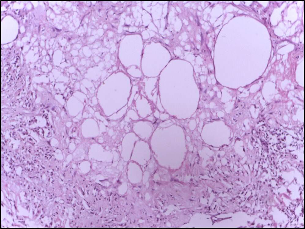 What is Skin Necrosis and Can I Prevent It? R3 Wound Care & Hyperbarics