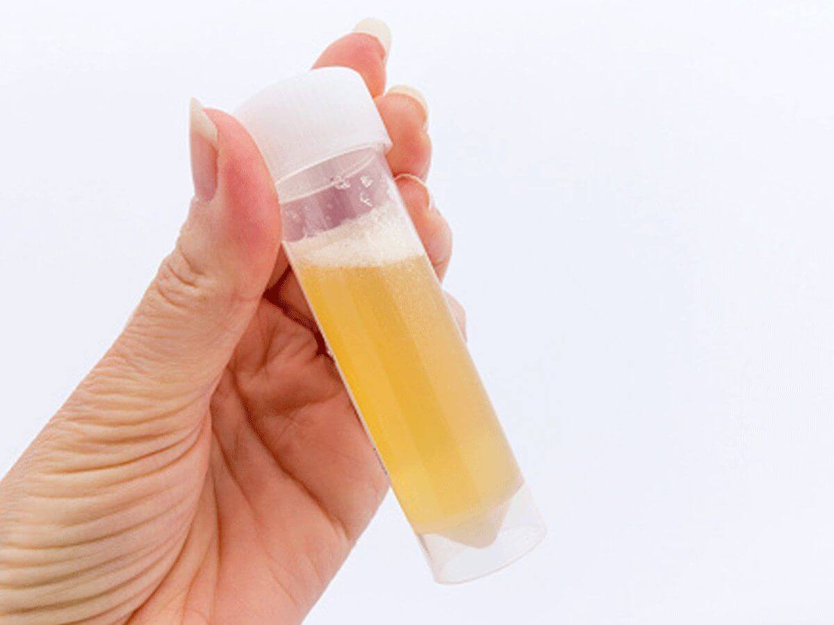 Foamy or Bubbly Urine Could Be Early Warning Sign of Kidney Damage