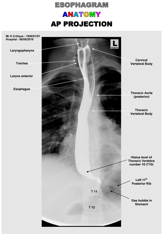 ESOPHAGRAM AP/OBLIQUE/LATERAL ANATOMY Radcrit