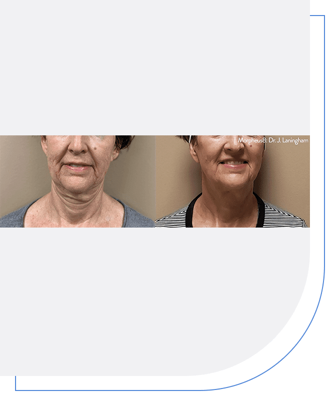 Morpheus8 Radiant Revival Aesthetics & Weight Loss Clinic