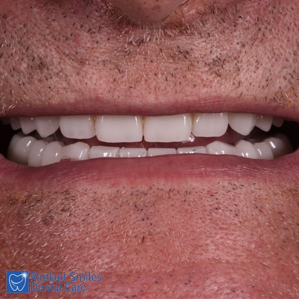 Dental Implants PERTH Cost Best Affordable Tooth Implant Prices 2023