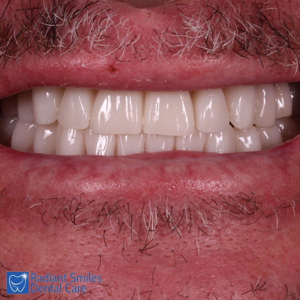 Dental Implants PERTH Cost Best Affordable Tooth Implant Prices 2023