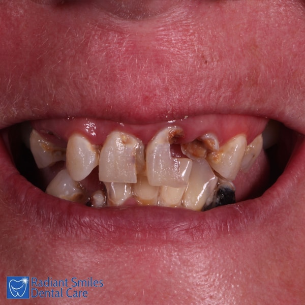 Dental Implants PERTH Cost Best Affordable Tooth Implant Prices 2023