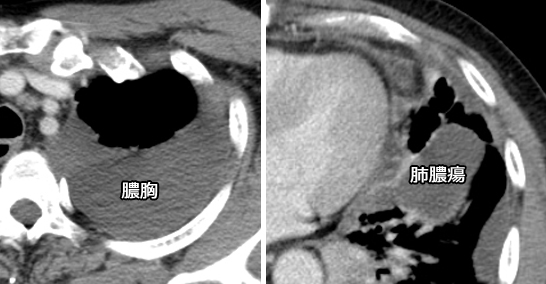膿胸と肺膿瘍の違いは？鑑別に「split pleura sign」が便利 - 読影を中心にRadioGraphica -診療放射線 …