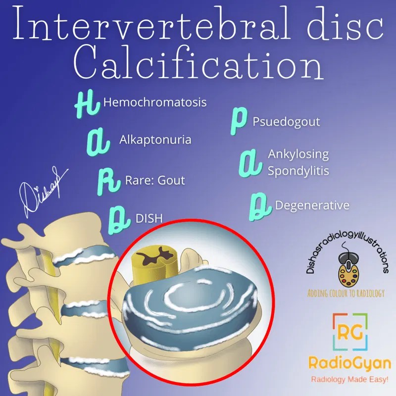 Causes Of Intervertebral Disc Calcification Visual Mnemonics RadioGyan