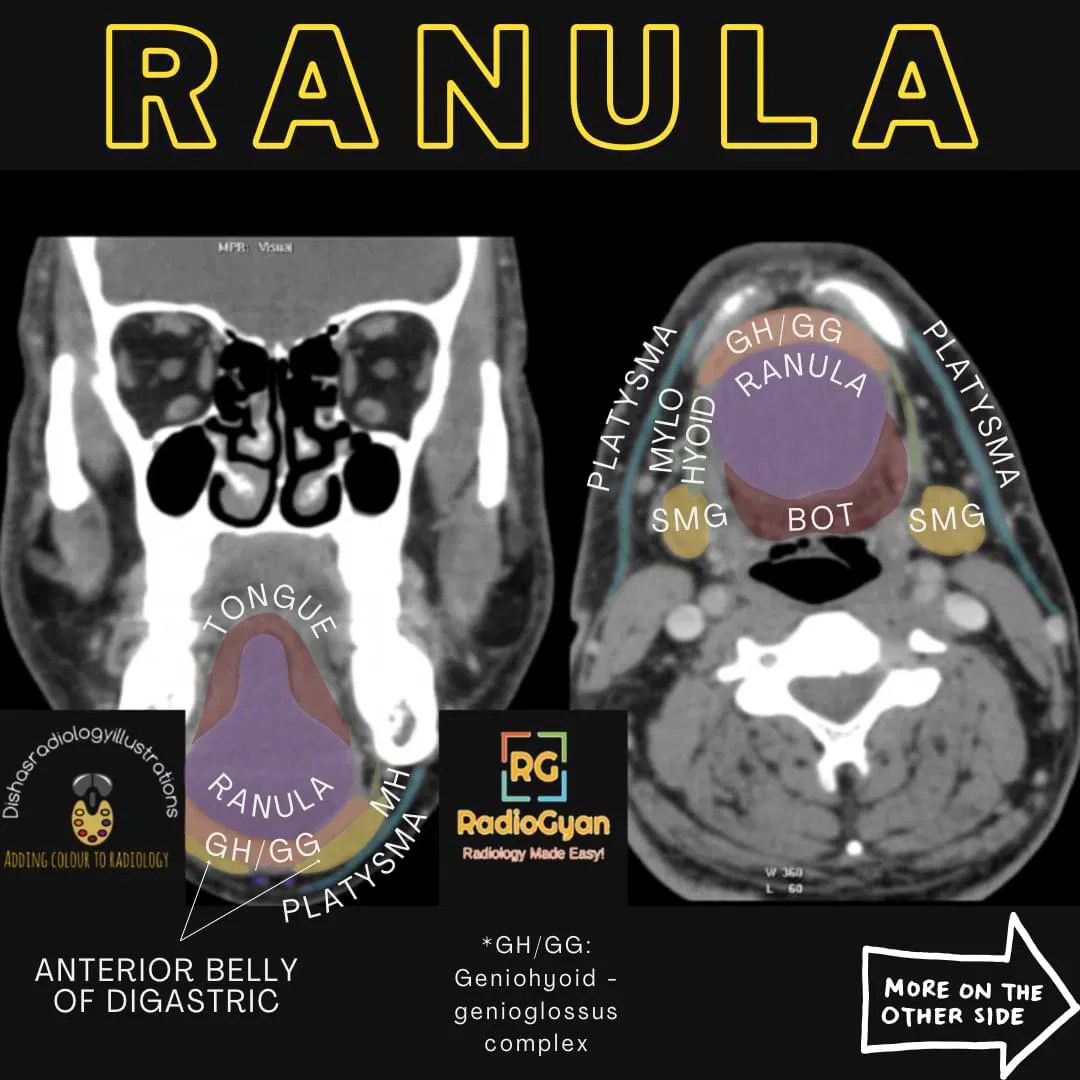 Ranula Radiology Case RadioGyan