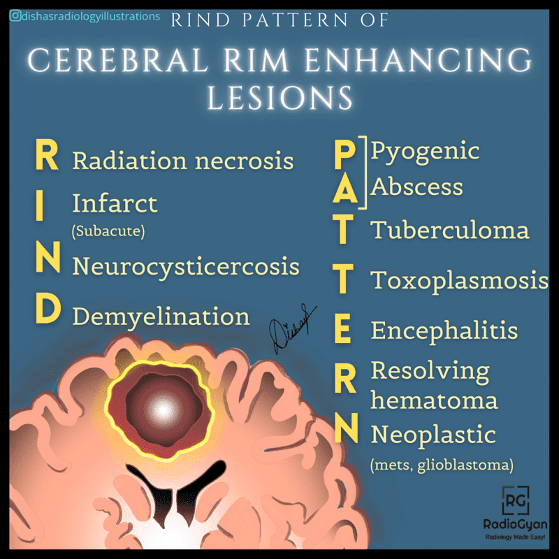 Causes Of Cerebral Rim Enhancing Lesions Visual Mnemonics RadioGyan