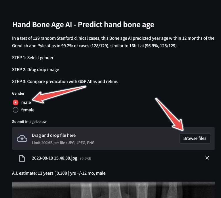 Calculating Bone Age Using Xrays [Includes AIbased Automated Tools